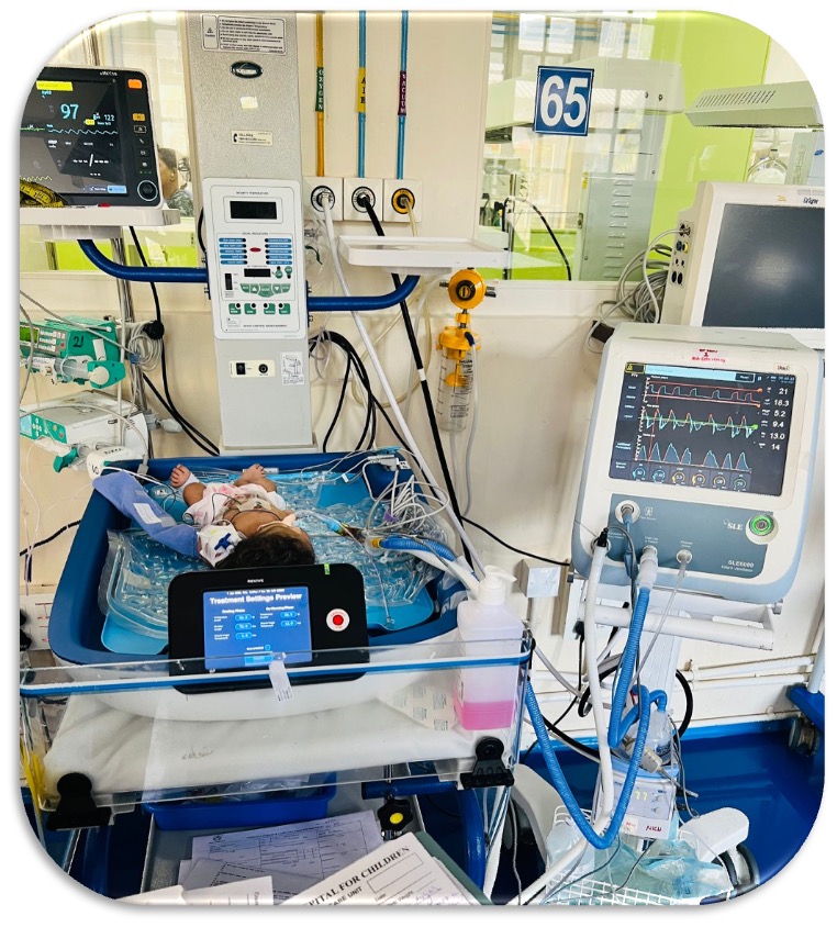 Real hospital NICU setting showing newborn baby receiving treatment with REVIVE cooling system (blue cooling blanket/mattress), surrounded by comprehensive monitoring equipment including vital signs monitors, ventilator, and various medical devices. Professional hospital environment with bed number 65 visible, showcasing actual clinical implementation of the REVIVE technology